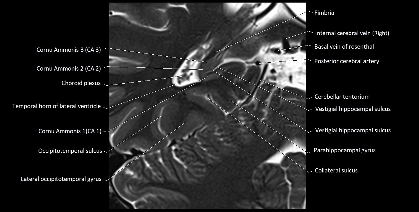 Hippocampus anatomy mri coronal cross section 3T MRI image 17.webp